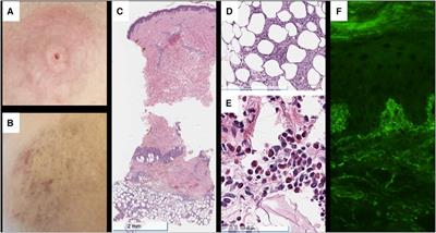 A case report and systematic literature review: insulin-induced type III hypersensitivity reaction